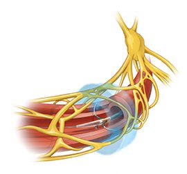 Medical illustration of an artery surrounded by nerves. A blue halo that represents ethyl alcohol circles the artery.